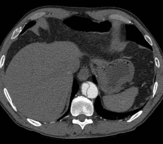 Aortic dissection - Stanford type B (Radiopaedia 73648-84437 A 99).jpg