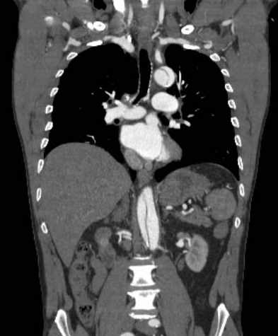 File:Aortic dissection - Stanford type B (Radiopaedia 73648-84437 B 64).jpg