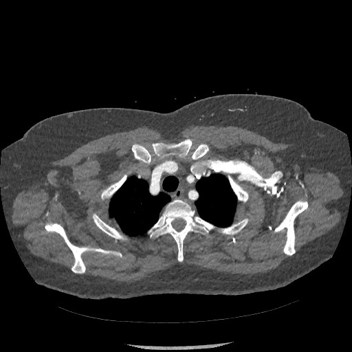 Aortic dissection - Stanford type B (Radiopaedia 88281-104910 A 7).jpg