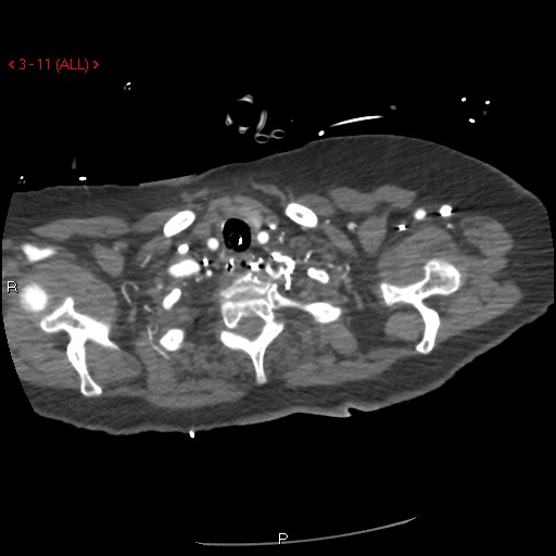 Aortic intramural hematoma (Radiopaedia 27746-28001 A 11).jpg
