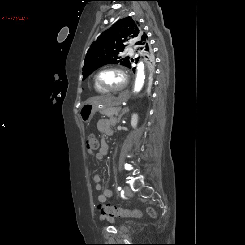 Aortic intramural hematoma (Radiopaedia 27746-28001 C 46).jpg