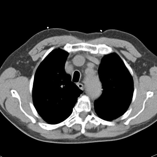 Aortic intramural hematoma (Radiopaedia 31139-31838 Axial non-contrast 14).jpg