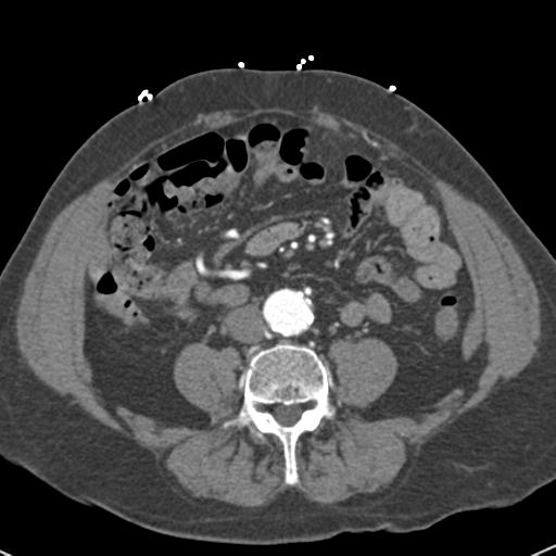 Aortic intramural hematoma (Radiopaedia 31139-31838 B 120).jpg