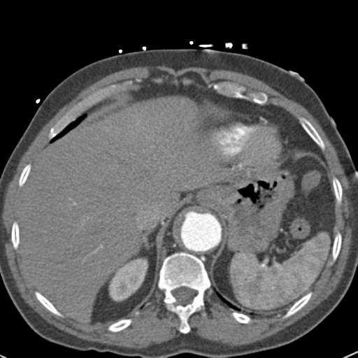 Aortic intramural hematoma (Radiopaedia 31139-31838 B 76).jpg
