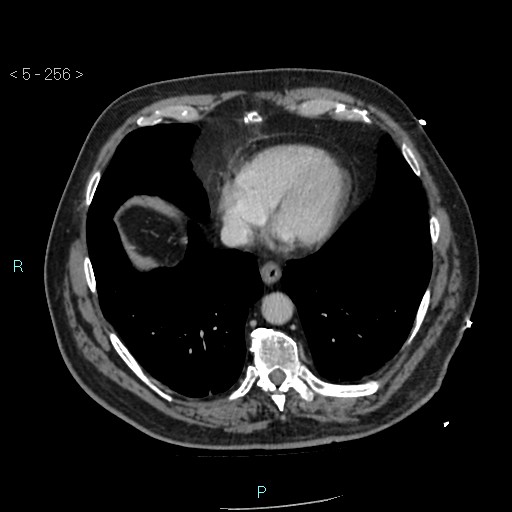 Aortic intramural hematoma (Radiopaedia 48463-53380 C 116).jpg