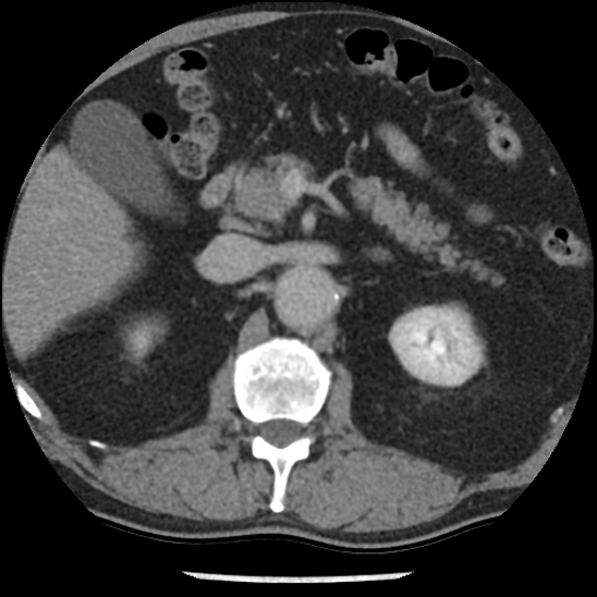 Aortic intramural hematoma (type B) (Radiopaedia 79323-92387 Axial C+ delayed 63).jpg