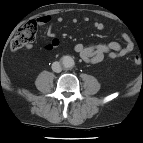 Aortic intramural hematoma (type B) (Radiopaedia 79323-92387 Axial C+ delayed 81).jpg