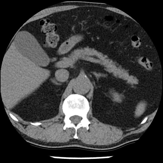 Aortic intramural hematoma (type B) (Radiopaedia 79323-92387 Axial non-contrast 59).jpg