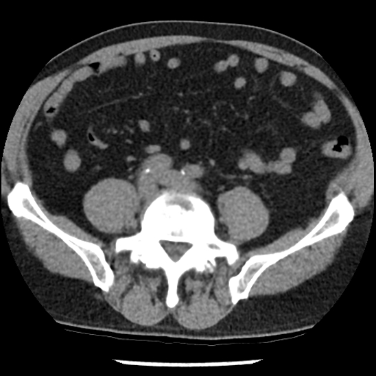 Aortic intramural hematoma (type B) (Radiopaedia 79323-92387 Axial non-contrast 86).jpg