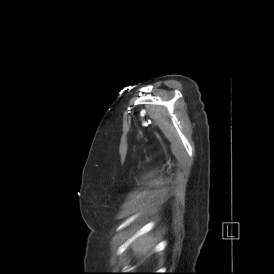 Aortic intramural hematoma with dissection and intramural blood pool (Radiopaedia 77373-89491 D 2).jpg