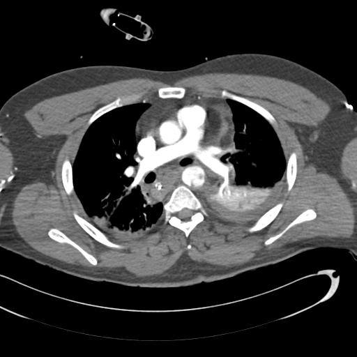 Aortic transection, diaphragmatic rupture and hemoperitoneum in a complex multitrauma patient (Radiopaedia 31701-32622 A 38).jpg
