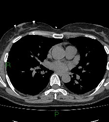 Aortic valve endocarditis (Radiopaedia 87209-103485 Axial non-contrast 54).jpg