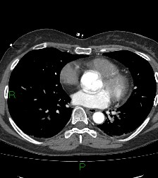 Aortic valve endocarditis (Radiopaedia 87209-103485 C 57).jpg