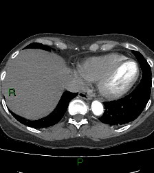 Aortic valve endocarditis (Radiopaedia 87209-103485 C 75).jpg