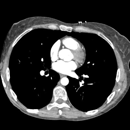 File:Aortic valve non-coronary cusp thrombus (Radiopaedia 55661-62189 A 4).png