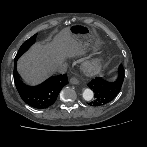 File:Aorto-coronary bypass graft aneurysms (Radiopaedia 40562-43157 A 99).png