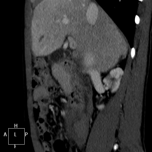 Aorto-left renal vein fistula (Radiopaedia 45534-49628 C 10).jpg