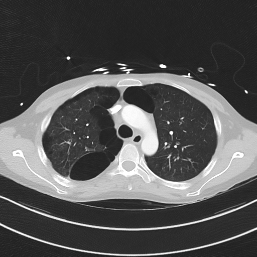Apical bullous disease in a heavy smoker (Radiopaedia 33067-34092 Axial lung window 20).png