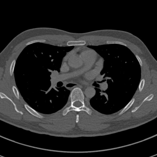 Apical lung mass mimic - neurogenic tumor (Radiopaedia 59918-67521 Axial bone window 39).jpg