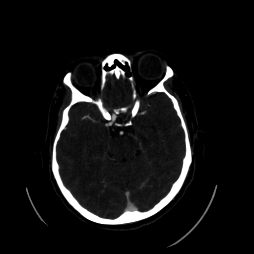 Aplasia of the internal carotid artery (Radiopaedia 61082-68960 A 26).jpg