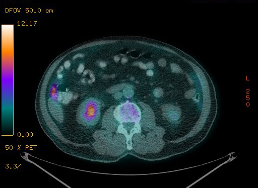 Appendiceal adenocarcinoma complicated by retroperitoneal abscess (Radiopaedia 58007-65041 Axial PET-CT 131).jpg