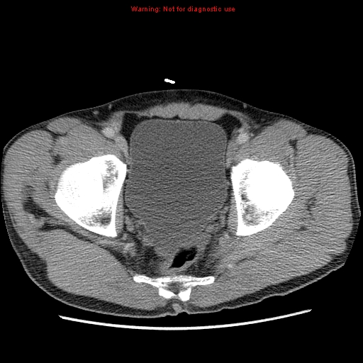 File:Appendicitis and renal cell carcinoma (Radiopaedia 17063-16760 A 52).jpg