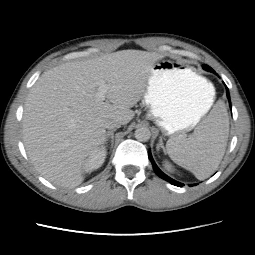 File:Appendicitis complicated by post-operative collection (Radiopaedia 35595-37114 A 20).jpg
