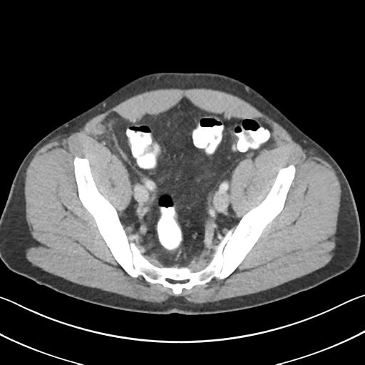 Appendicitis with cecal bar sign (Radiopaedia 31878-32830 B 66).jpg