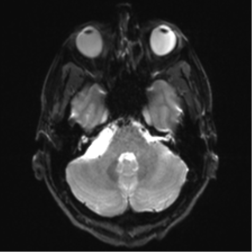 Arachnoid cyst - cerebellopontine angle (Radiopaedia 59689-67083 Axial DWI 9).png