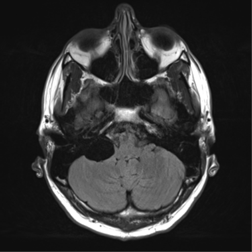 File:Arachnoid cyst - cerebellopontine angle (Radiopaedia 59689-67083 Axial FLAIR 8).png