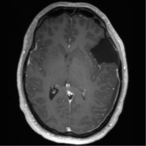 File:Arachnoid cyst with subdural hematoma (Radiopaedia 85892-101743 Axial T1 C+ 45).png