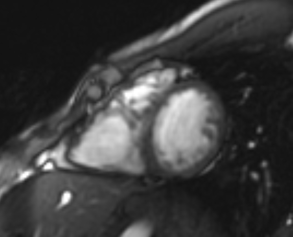 Arrhythmogenic right ventricular cardiomyopathy (Radiopaedia 69564-79464 short axis cine 111).jpg