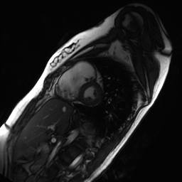 Arrhythmogenic right ventricular cardiomyopathy (Radiopaedia 87505-103850 short axis Cine SSFP 127).jpg
