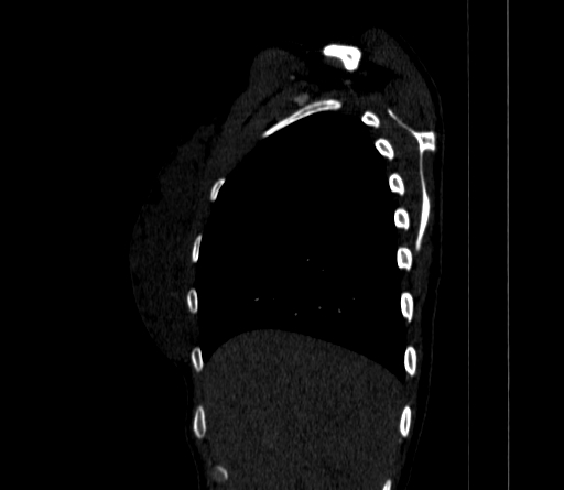 File:Arteria lusoria (Radiopaedia 88528-105192 C 24).jpg