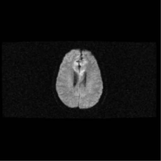 File:Arteriovenous malformation (cerebral) (Radiopaedia 40070-42580 Axial DWI 15).png