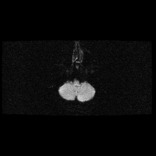 File:Arteriovenous malformation (cerebral) (Radiopaedia 40070-42580 Axial DWI 5).png