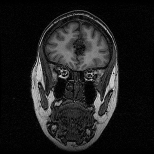 File:Arteriovenous malformation (cerebral) (Radiopaedia 40070-42580 Coronal T1 47).png