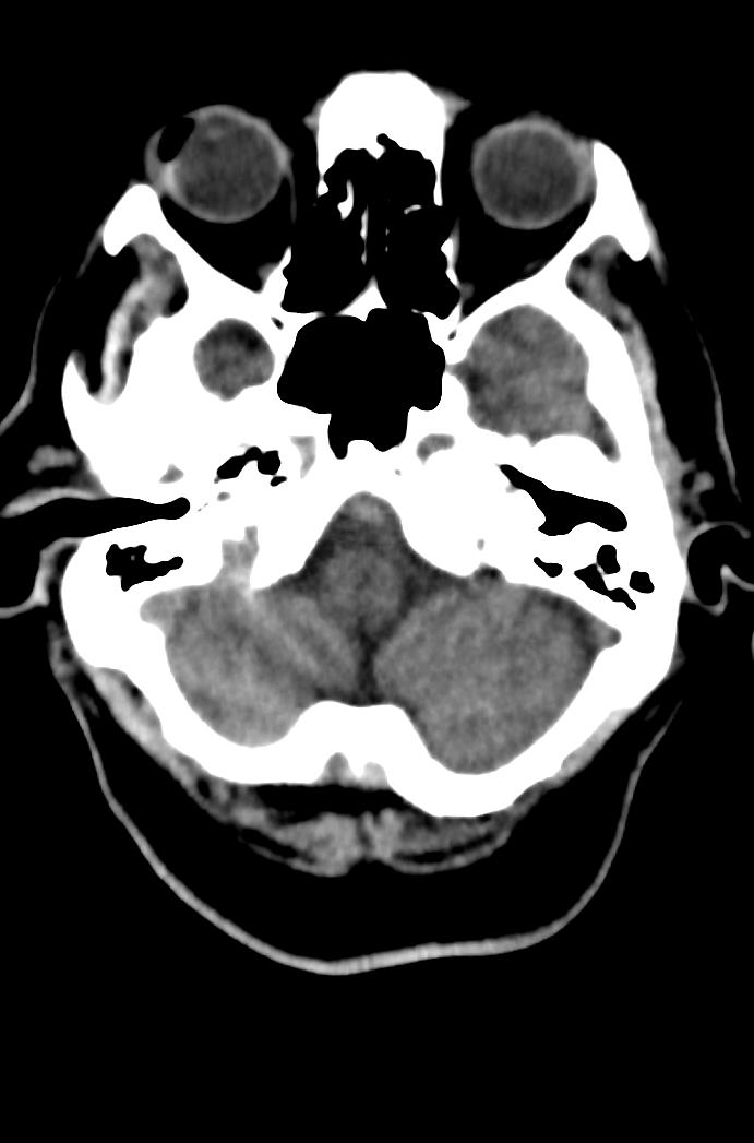 Artery of Percheron infarction (Radiopaedia 80613-94202 Axial non-contrast 42).jpg