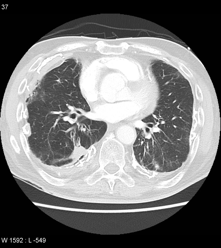 Asbestos related lung and pleural disease (Radiopaedia 14377-14301 A 34).jpg