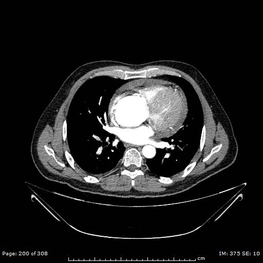 Ascending aortic aneurysm (Radiopaedia 50086-55404 A 52).jpg