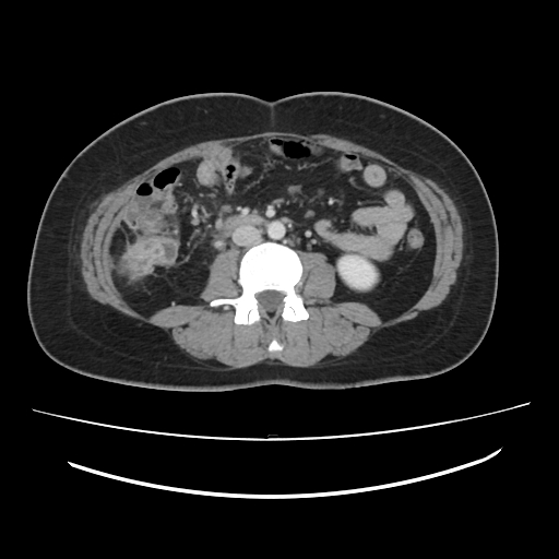 Ascending retrocecal appendicitis with liver abscesses (Radiopaedia 60066-67615 B 50).jpg