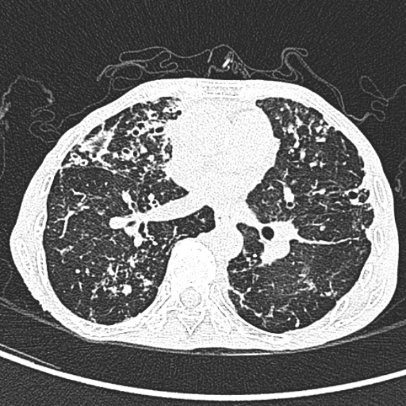 Aspergilloma- with Monod sign (Radiopaedia 44737-48532 Axial lung window 146).jpg