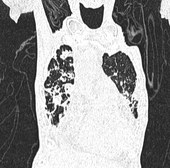 Aspergilloma- with Monod sign (Radiopaedia 44737-48532 Coronal lung window 150).jpg