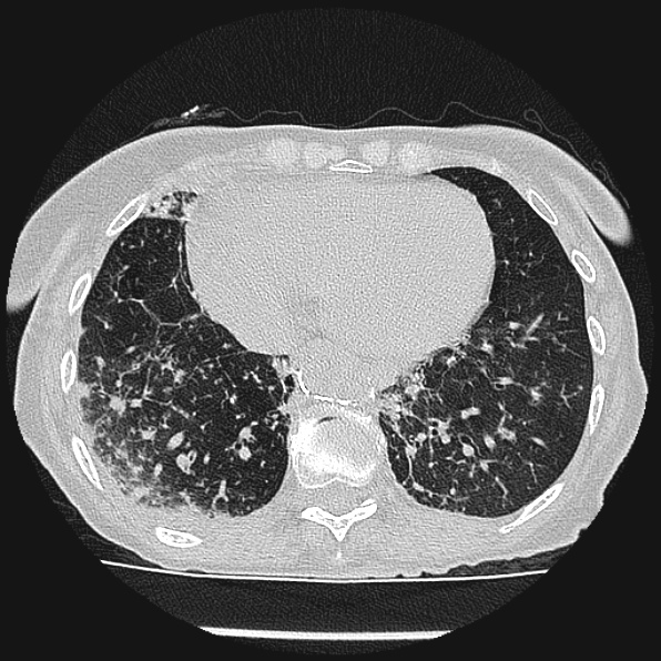Aspergilloma (Radiopaedia 24458-24763 Axial lung window 51).jpg