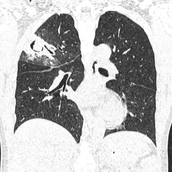 File:Aspergilloma (Radiopaedia 26223-26347 Coronal lung window 31).jpg