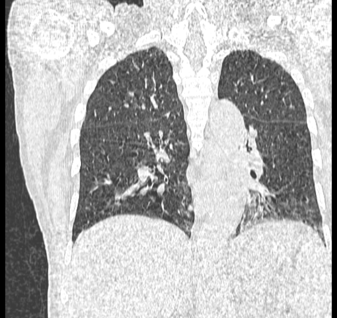 Aspergilloma (Radiopaedia 44592-48327 Coronal lung window 83).jpg