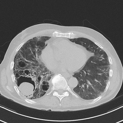 Aspergilloma on background pulmonary fibrosis (Radiopaedia 60942-68757 A 37).jpg