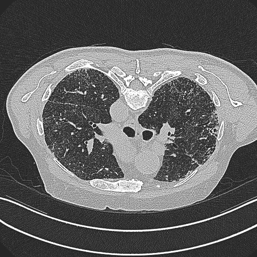 File:Aspergilloma on background pulmonary fibrosis (Radiopaedia 60942-68757 Axial lung window 2).jpg