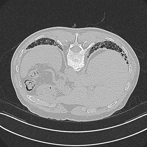 File:Aspergilloma on background pulmonary fibrosis (Radiopaedia 60942-68757 Axial lung window 34).jpg