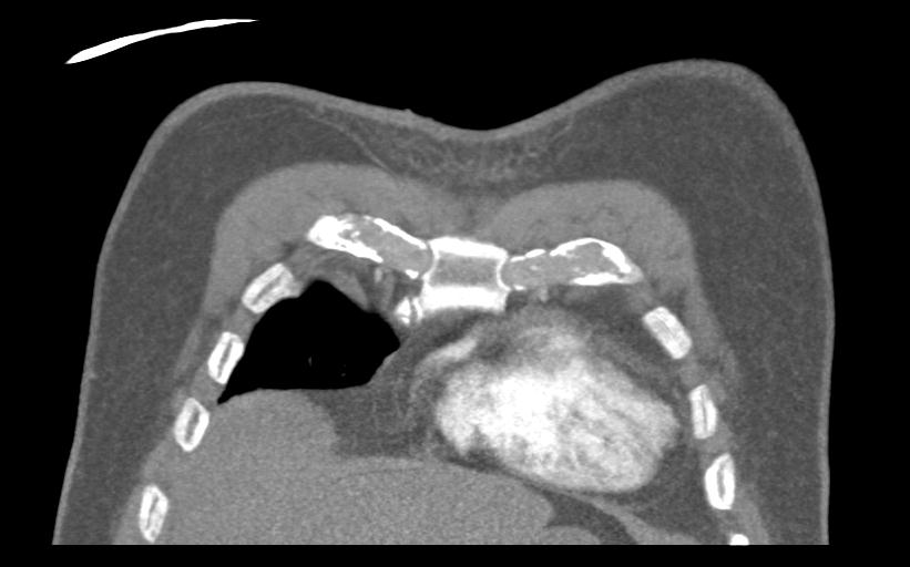 Aspirated tooth (Radiopaedia 28584-28844 Coronal C+ CTPA 12).jpg